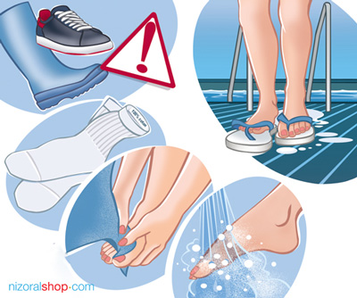 Illustration of how to prevent Athlete's Foot Tinea Pedis