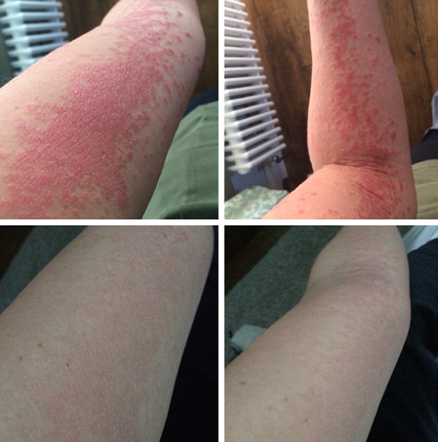 These pictures show the dramatic change in the interior designer's skin on her arm