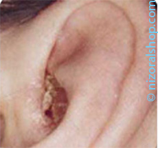 Cracked Skin in Ear Canal, sign of Ear Psoriasis.