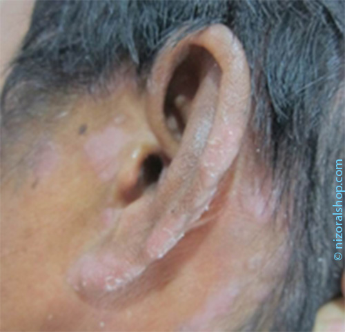 Man with Psoriasis around and inside the ear