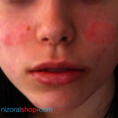 Woman showing symptoms of eczema on face