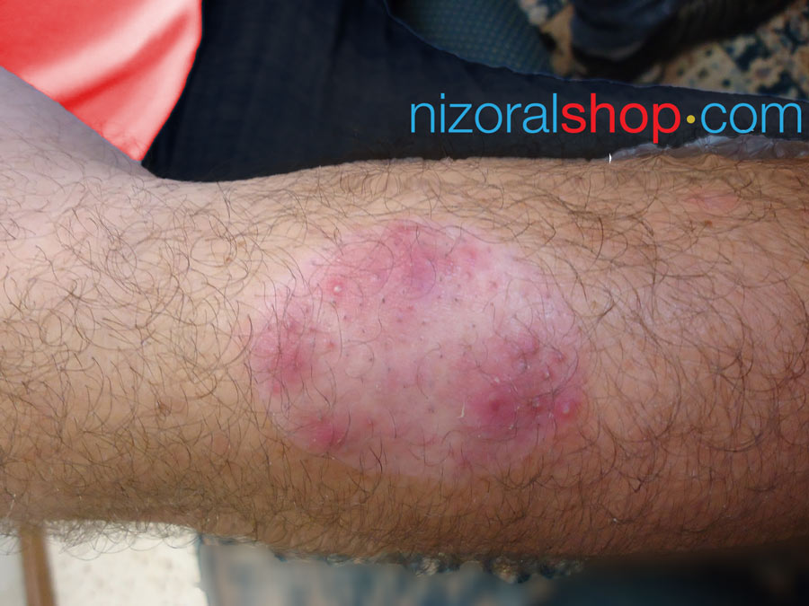 Man displaying symptoms of Nummular Eczema on his arm