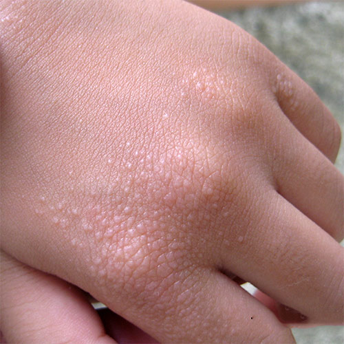 Patient developing small blisters on the hand