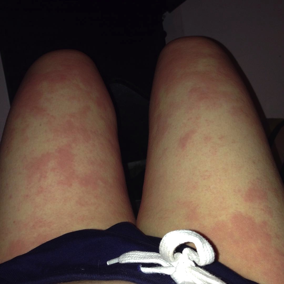 Woman suffering from Eczema on Legs (both thighs) red patches