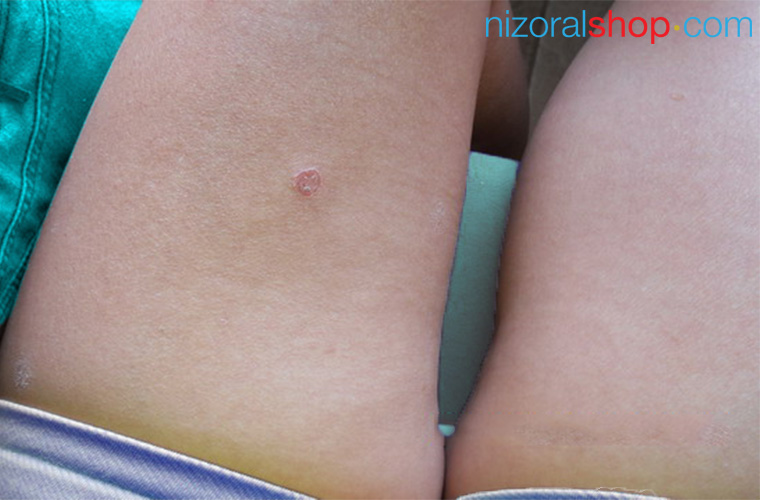Nummular Eczema is characterized by coin shaped lesions