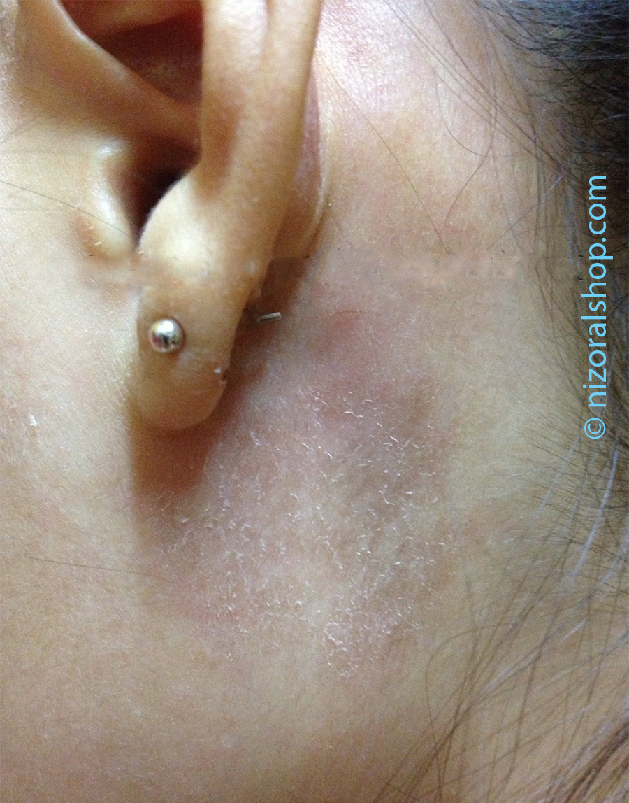 Woman with red scaly patches known as Ear psoriasis