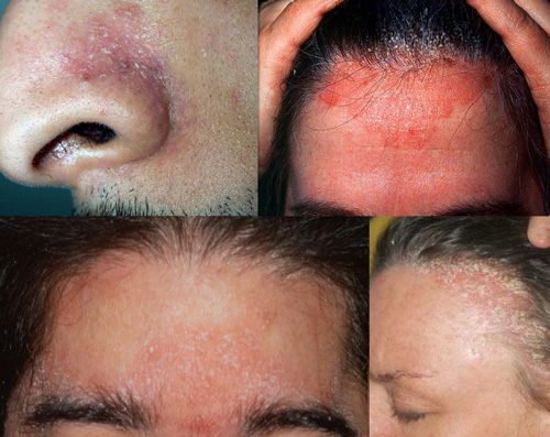 Four kinds of Seborrheic Dermatitis that can occur on the nose, hairline, scalp, eyebrows and forehead.