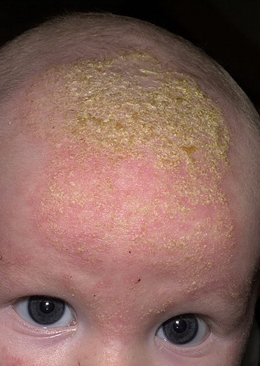 Baby showing signs of Seborrheic Dermatitis with yellow crust on the scalp.