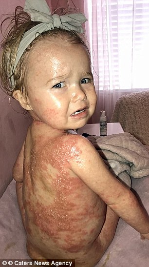 Ashley – who said some people have accused her of being 'a bad parent' when they've mistaken her daughter's psoriasis for severe sunburn – reports Charlie has found relief