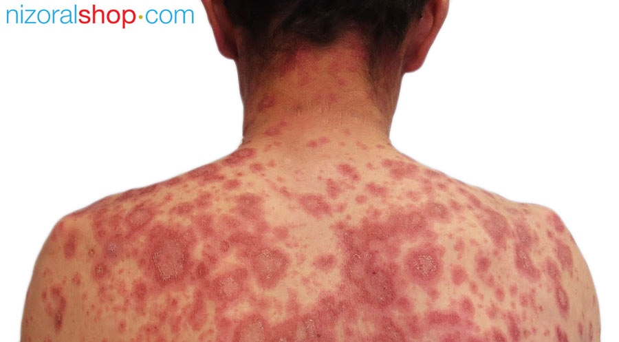 Woman showing symptoms of discoid eczema on back