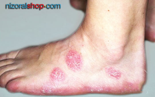 Patient suffering from foot nummular dermatitis