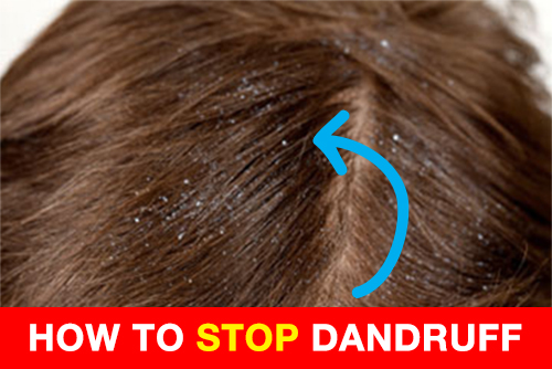 How To Get Rid Of Dandruff in 4 Simple Steps
