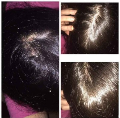 Before and after results of using Nizoral Shampoo in combination with other treatments