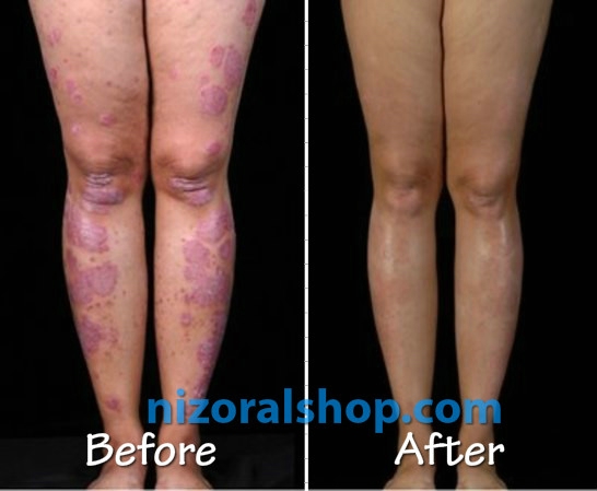 Berofe-After Psoriasis Result Using Nizoral Cream