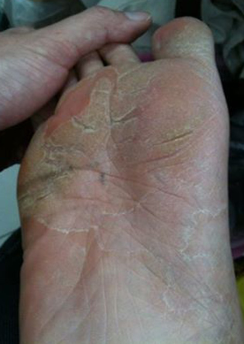 Plantar Athlete's Foot Symptoms or moccasin foot with chronic scaly tinea pedis