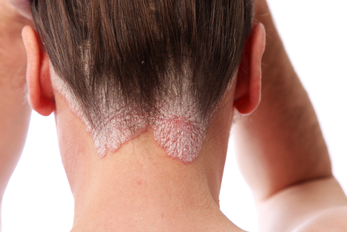 Scalp Psoriasis Treatment