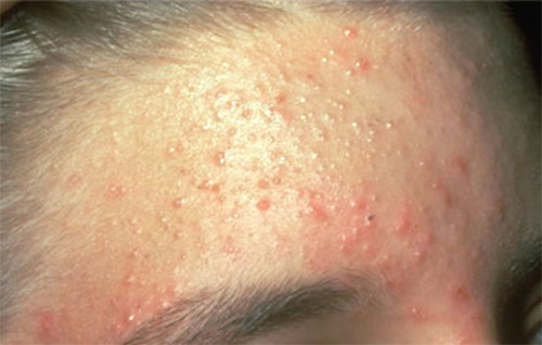 Woman with yeast infection on her forehead