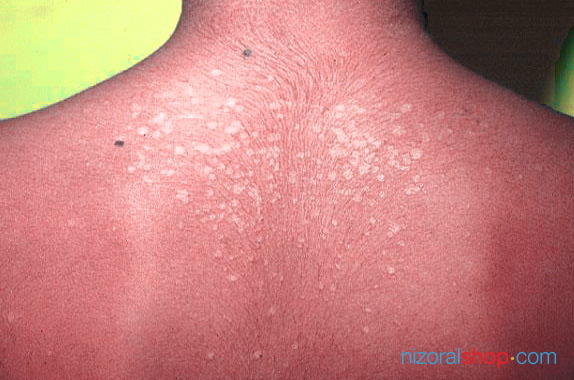 Patient suffering from skin discoloration on the back