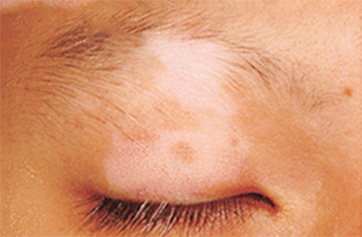 Patient with skin discoloration on eyelid