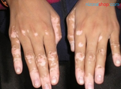 Individual suffering from Tinea Versicolor on both hands and fingers