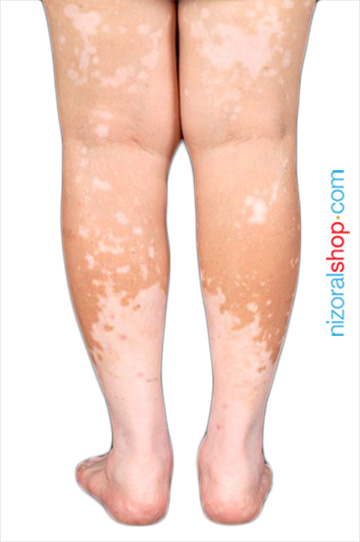Patient showing skin hyper pigmentation on both legs