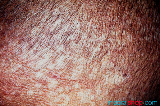 Tinea Versicolor can also affect scalp
