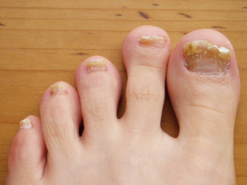Toenails showing signs of athlete's foot tinea pedis